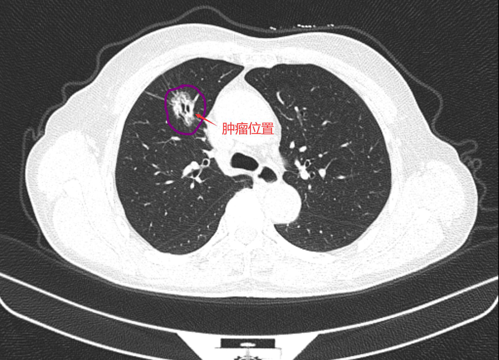 胸部CT示：右肺上叶不规则实性结节，大小约261x17cm，考虑为肺癌可能.png