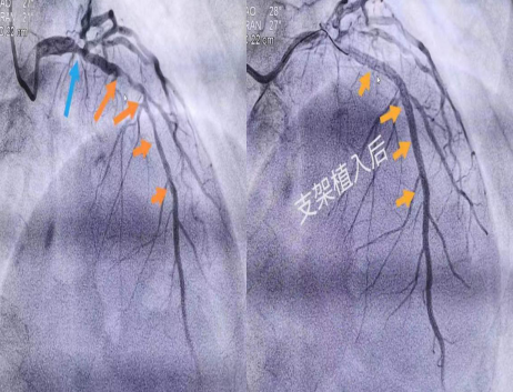 冠脉造影支架支架植入术前术后对比.jpg