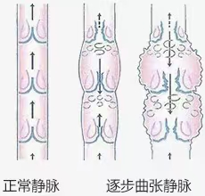 4正常静脉和逐步曲张静脉.png