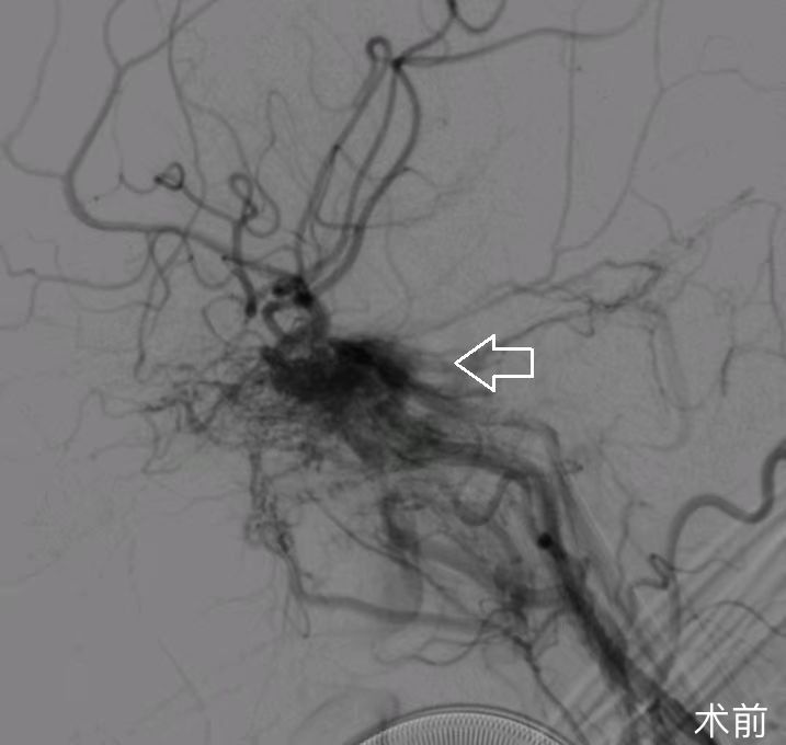 术前造影示海绵窦区硬脑膜动静脉瘘.jpg