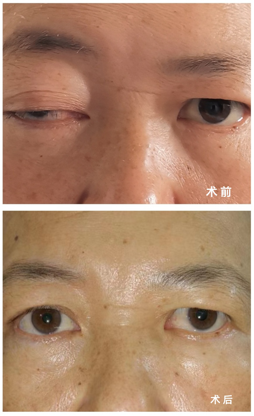 术前：右眼睑肿胀、突眼、闭合不全；术后：右眼睑恢复正常。.png