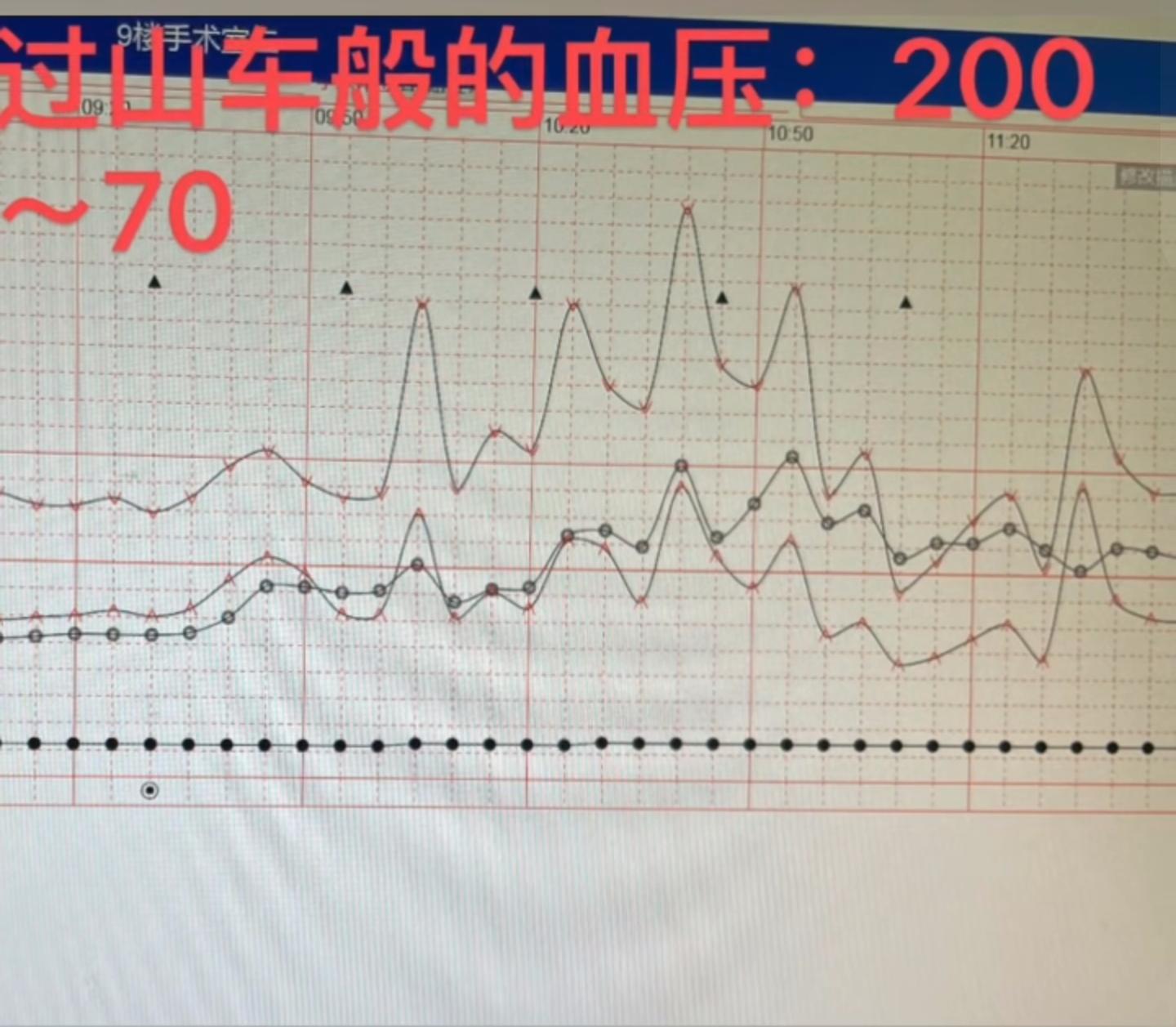 手术中血压.jpg