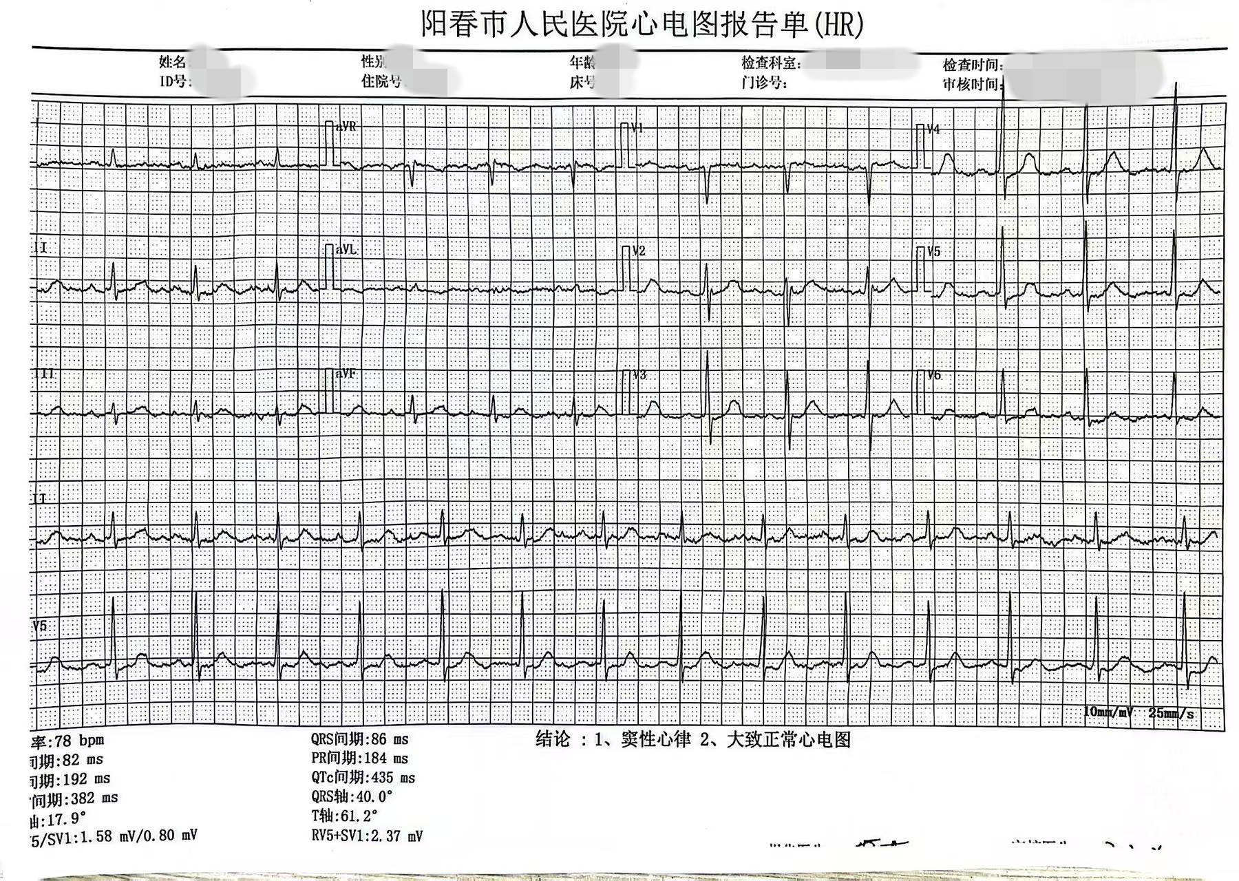 消融术后心电图.png