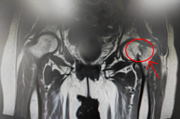 术前MRI.png