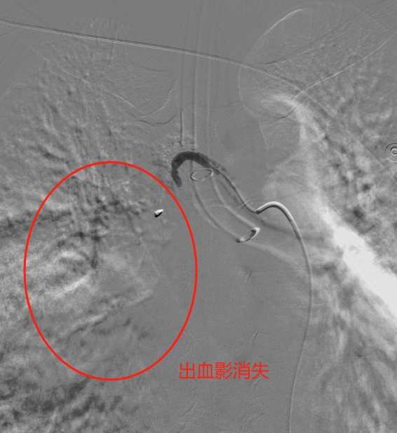 再造影见右肺出血影消失.png